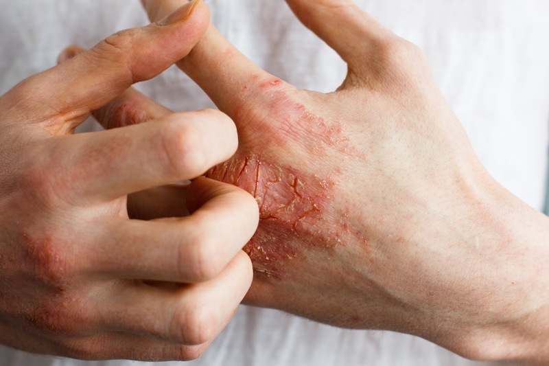 Vi khuẩn Pseudomonas aeruginosa trong nước uống – Nguy cơ sức khỏe & cách xử lý