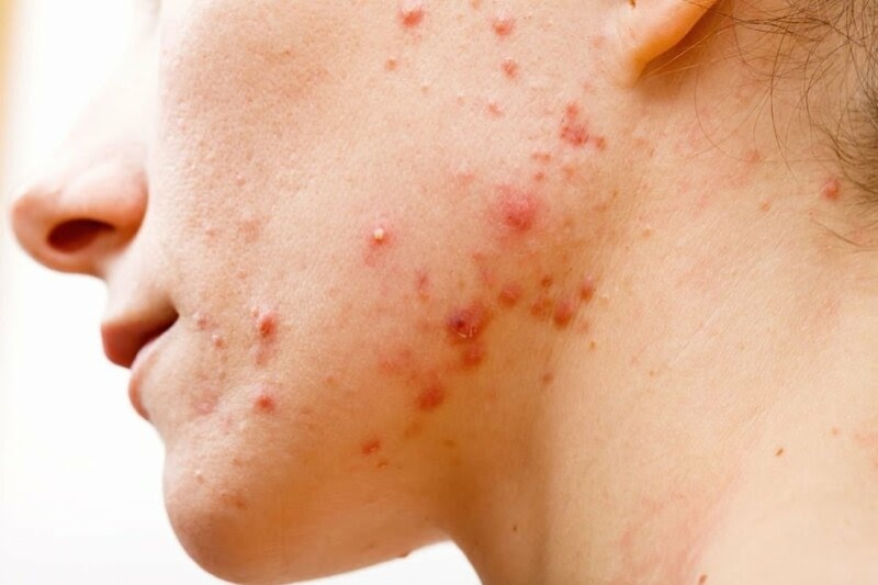 Vi khuẩn Pseudomonas aeruginosa trong nước uống – Nguy cơ sức khỏe & cách xử lý