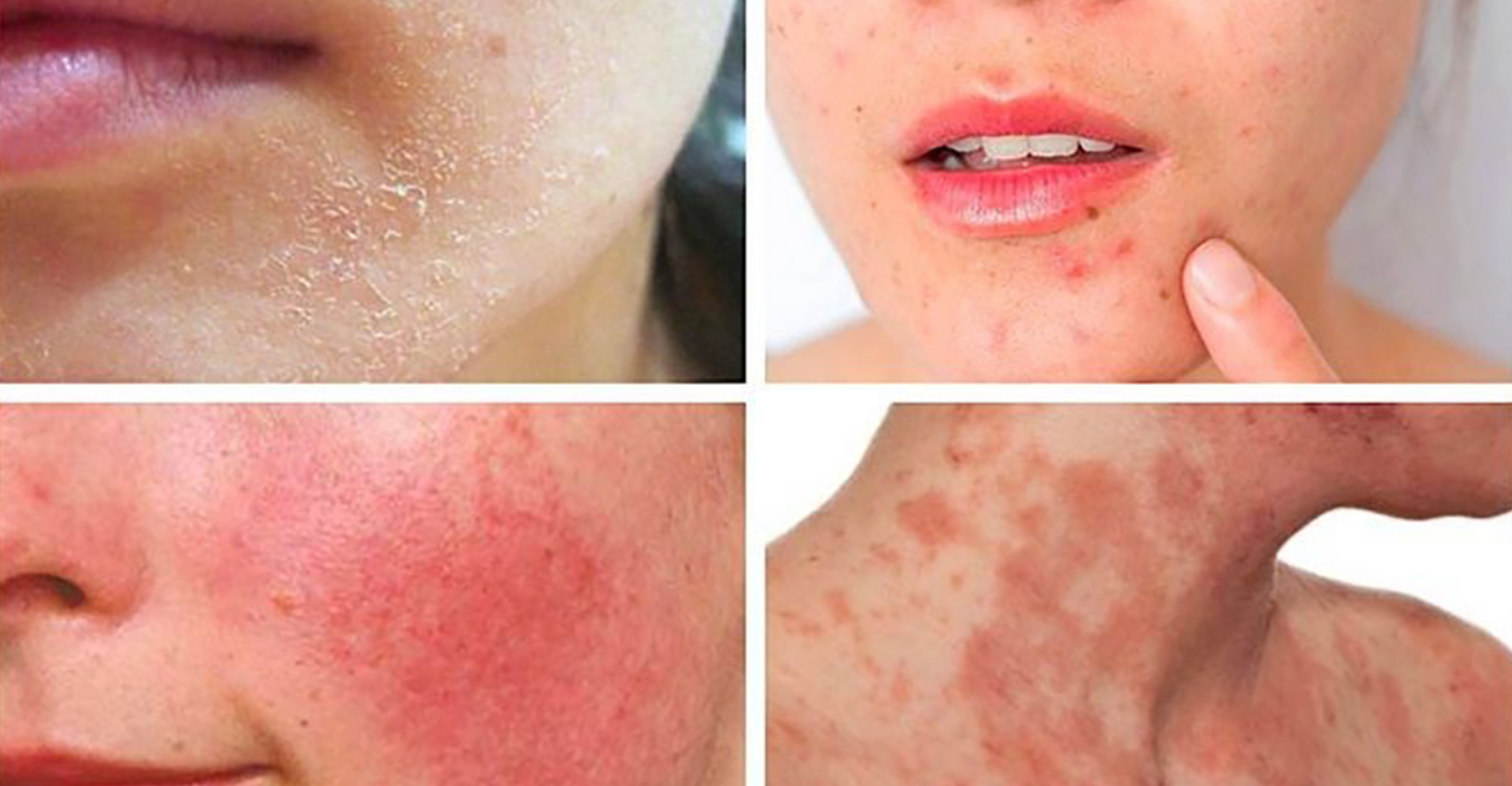 Hậu quả khi chưa xử lý nước mưa mà sử dụng